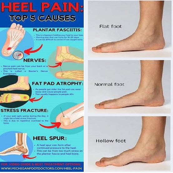 Heel Pain Top 5 Causes